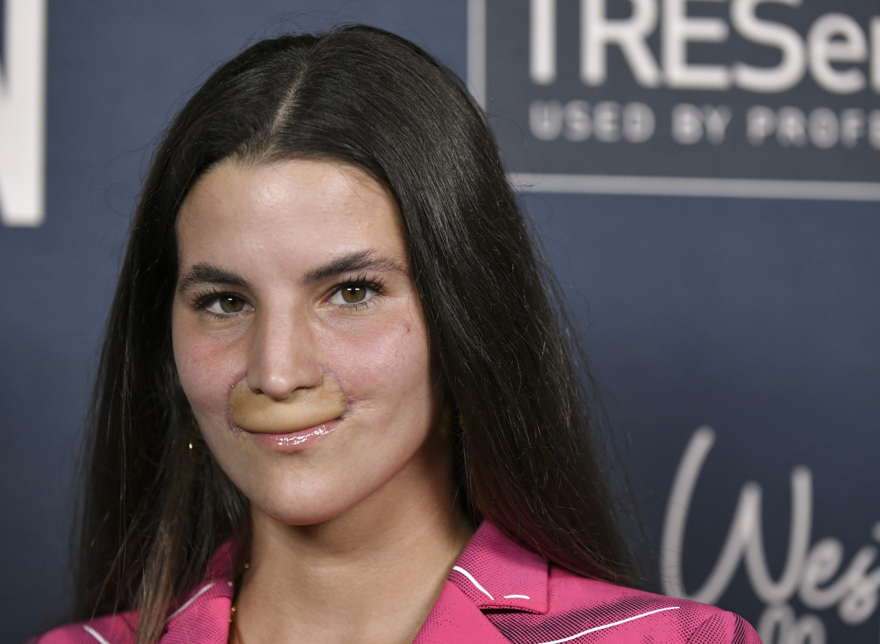 Pro Skateboarder And Model Shows Off New Face After Getting Mauled By A Pit Bull In 2020